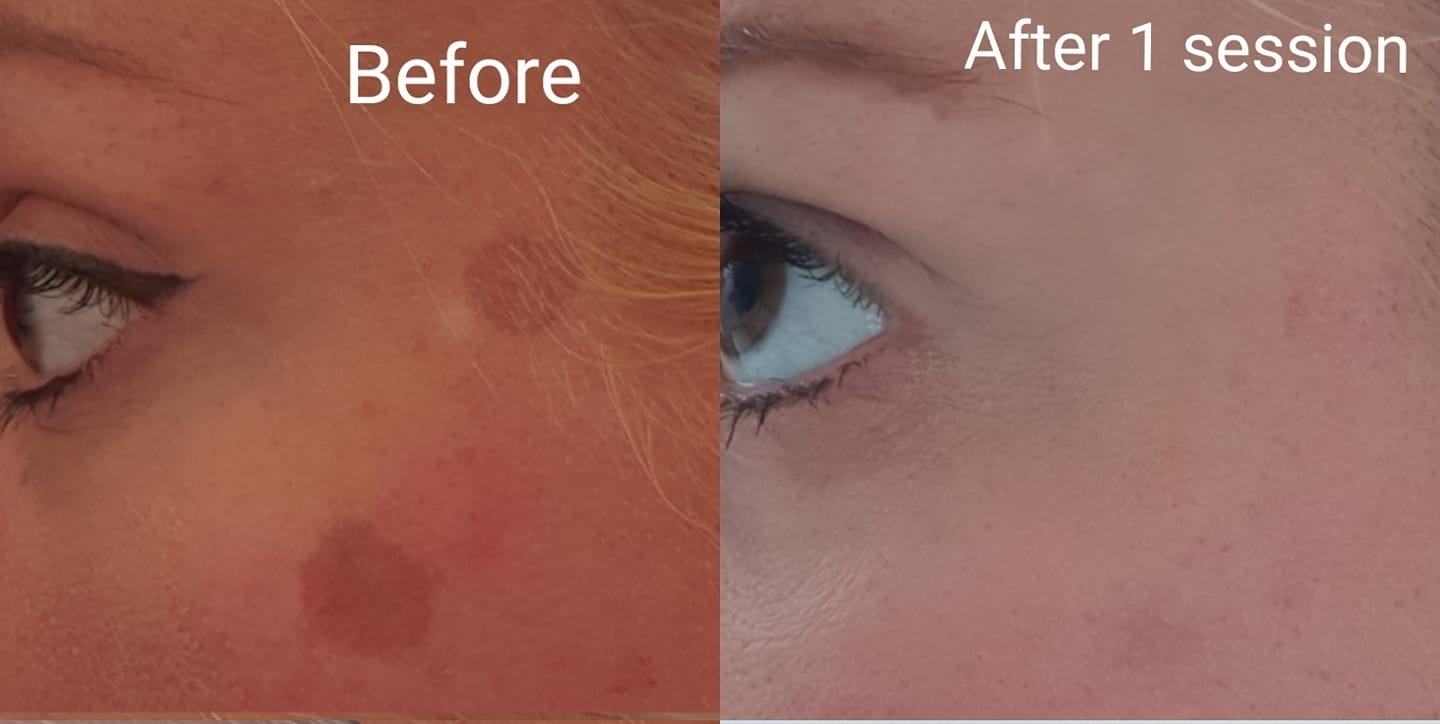 Biggleswade Katherine Lawson Laser removal & skin rejuvenation