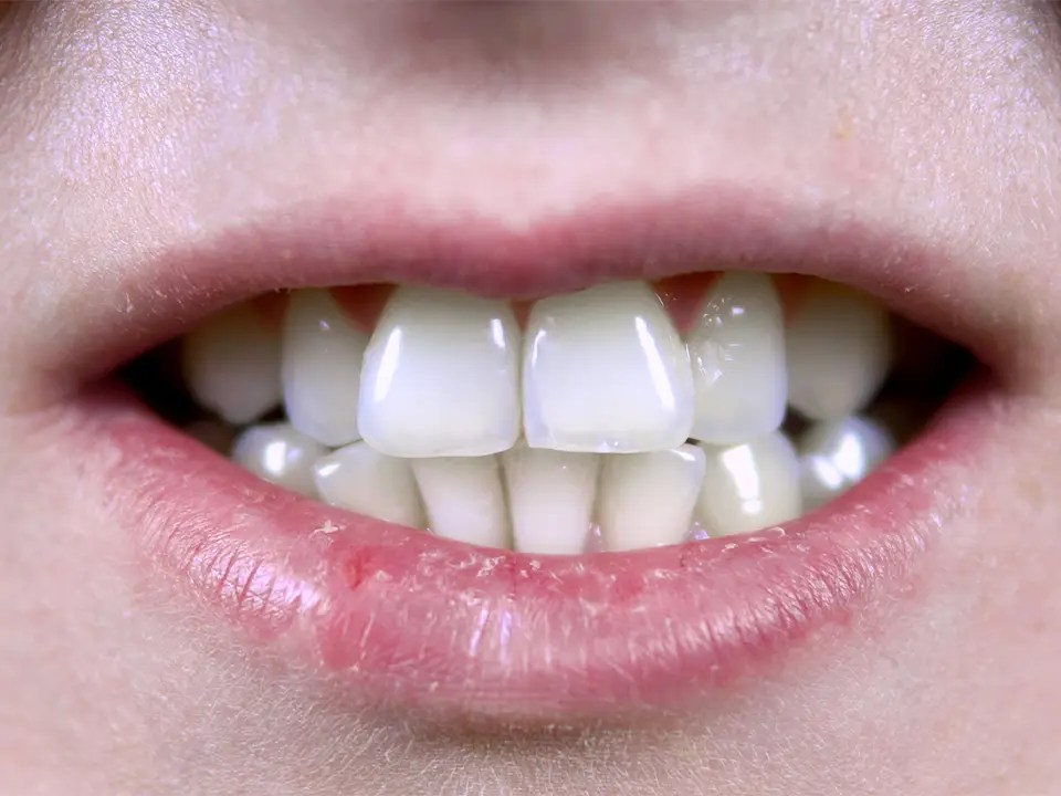 What is An Overbite? Education with Fillmore Dental Group