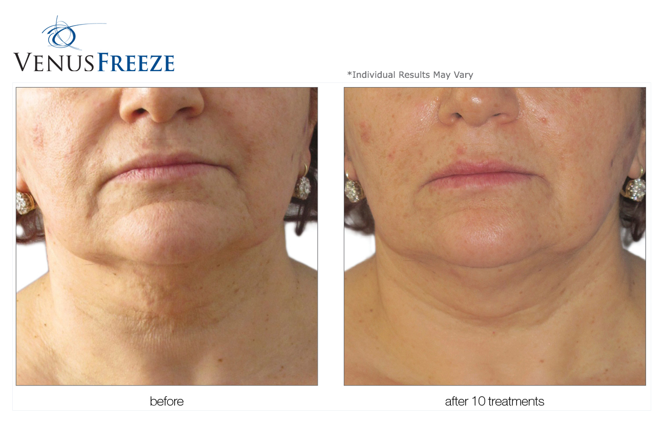 Best Med Spa Finale Hair RemovalCall Us 952.546.1774