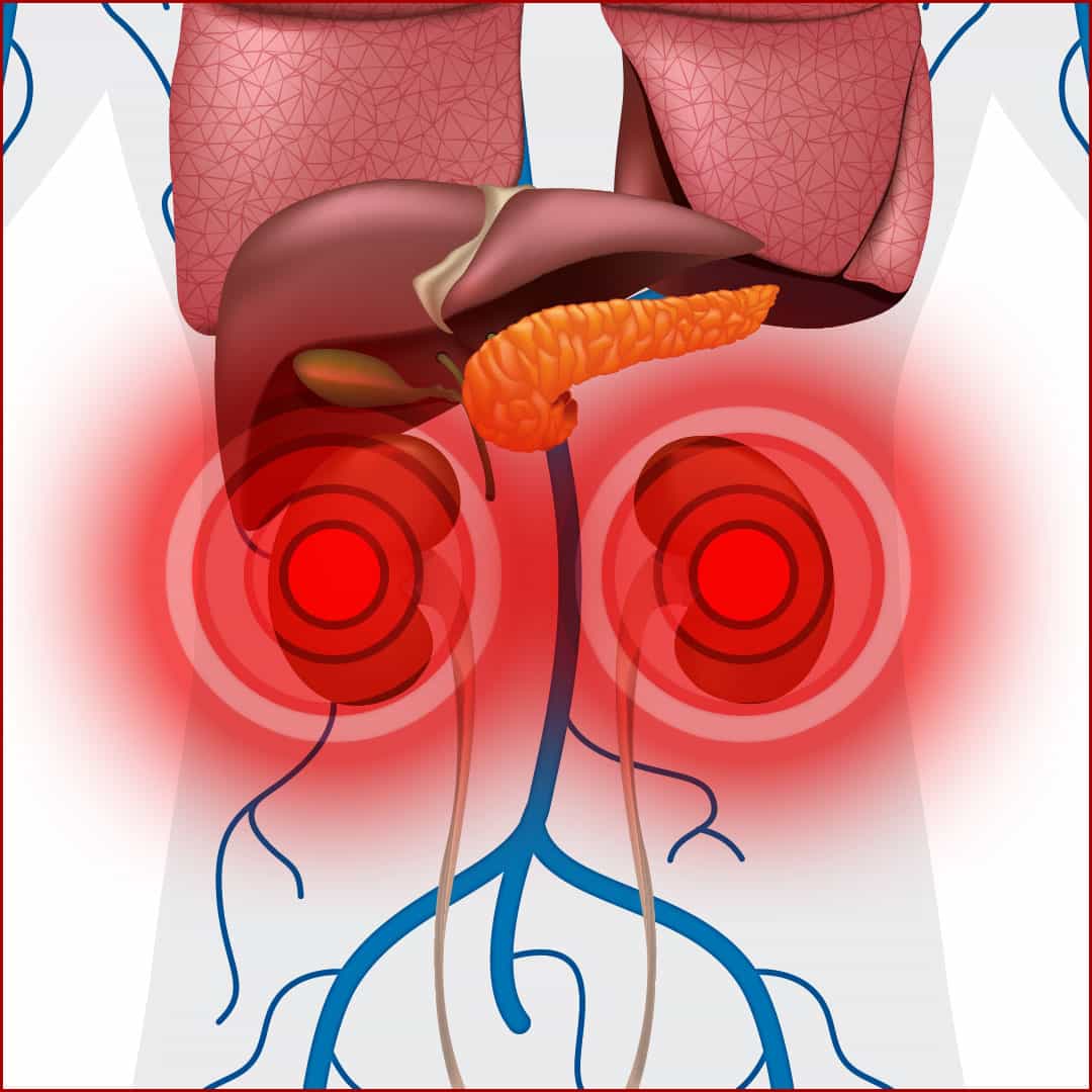 List 102+ Pictures Images Of Kidney Stones Updated
