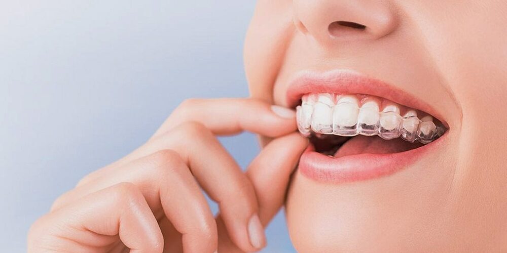 Clear Aligners Brace Free Orthodontics Treatment FineUp Blog