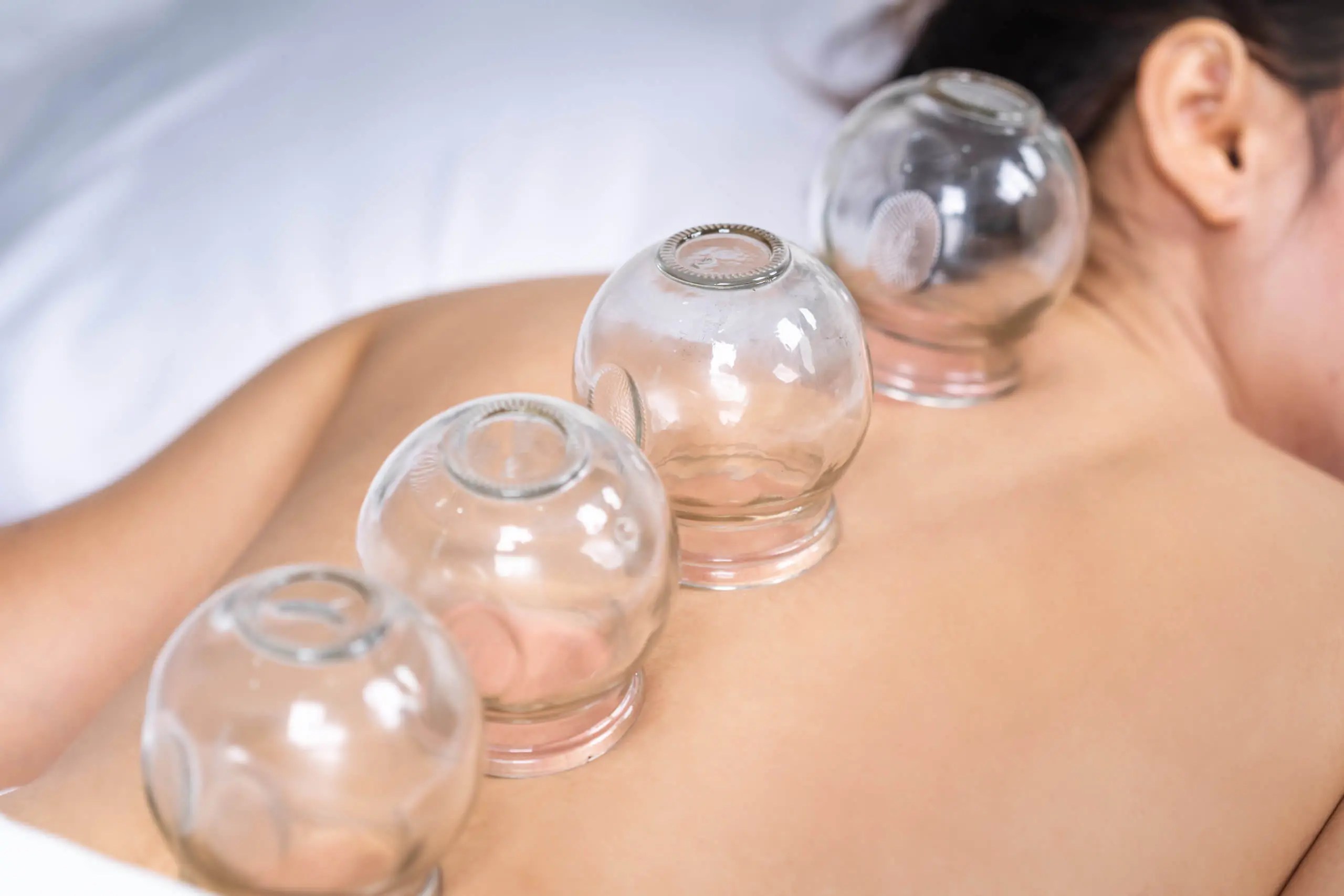 Is Cupping Scientifically Proven To Work? FiredOut