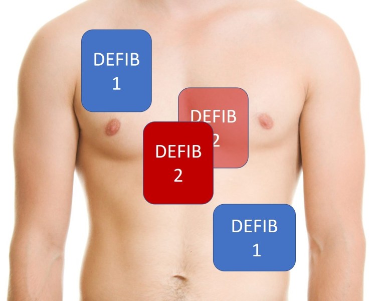 Dualdefibrillationpadplacement First10EM
