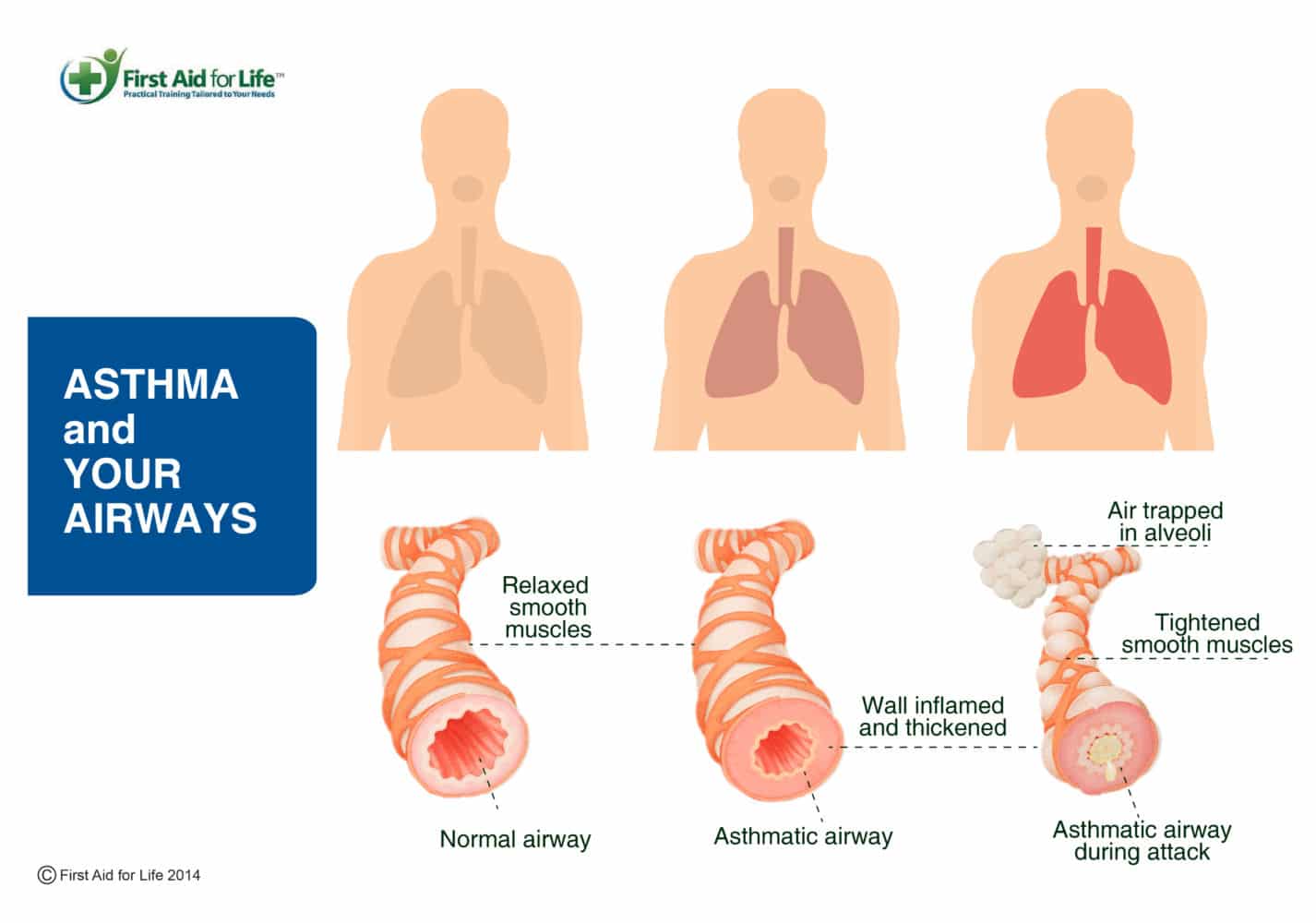 Asthma what it is and how to help if someone is having an asthma attack