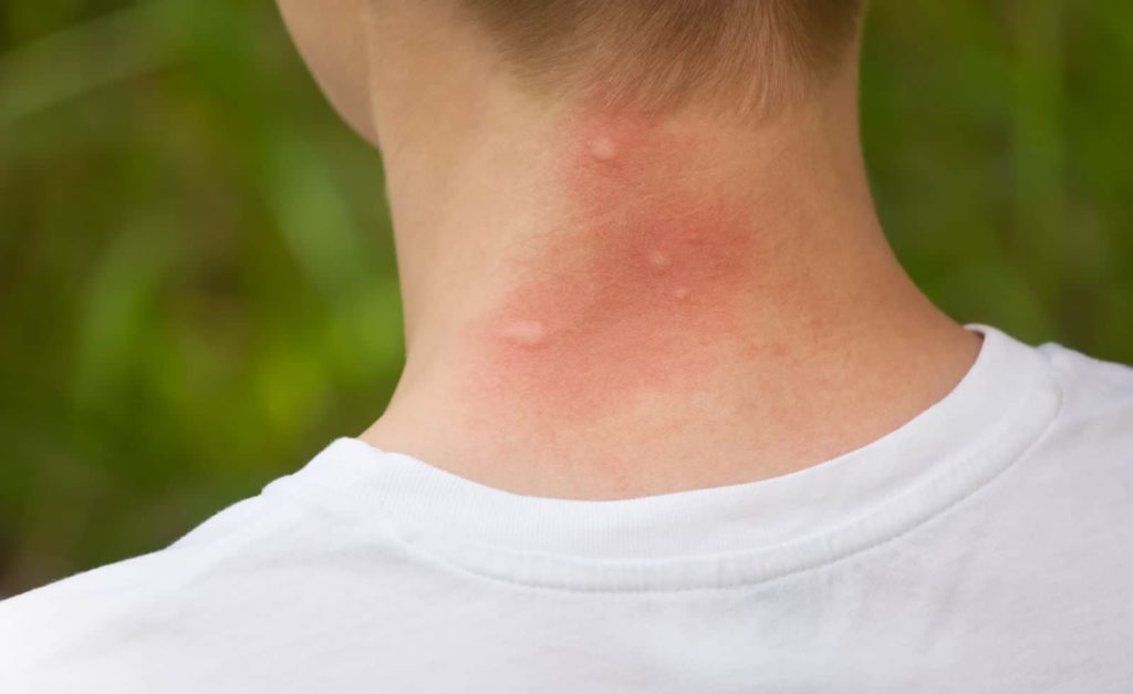 What Bit Me? The Ultimate Guide to Common Bites and Stings