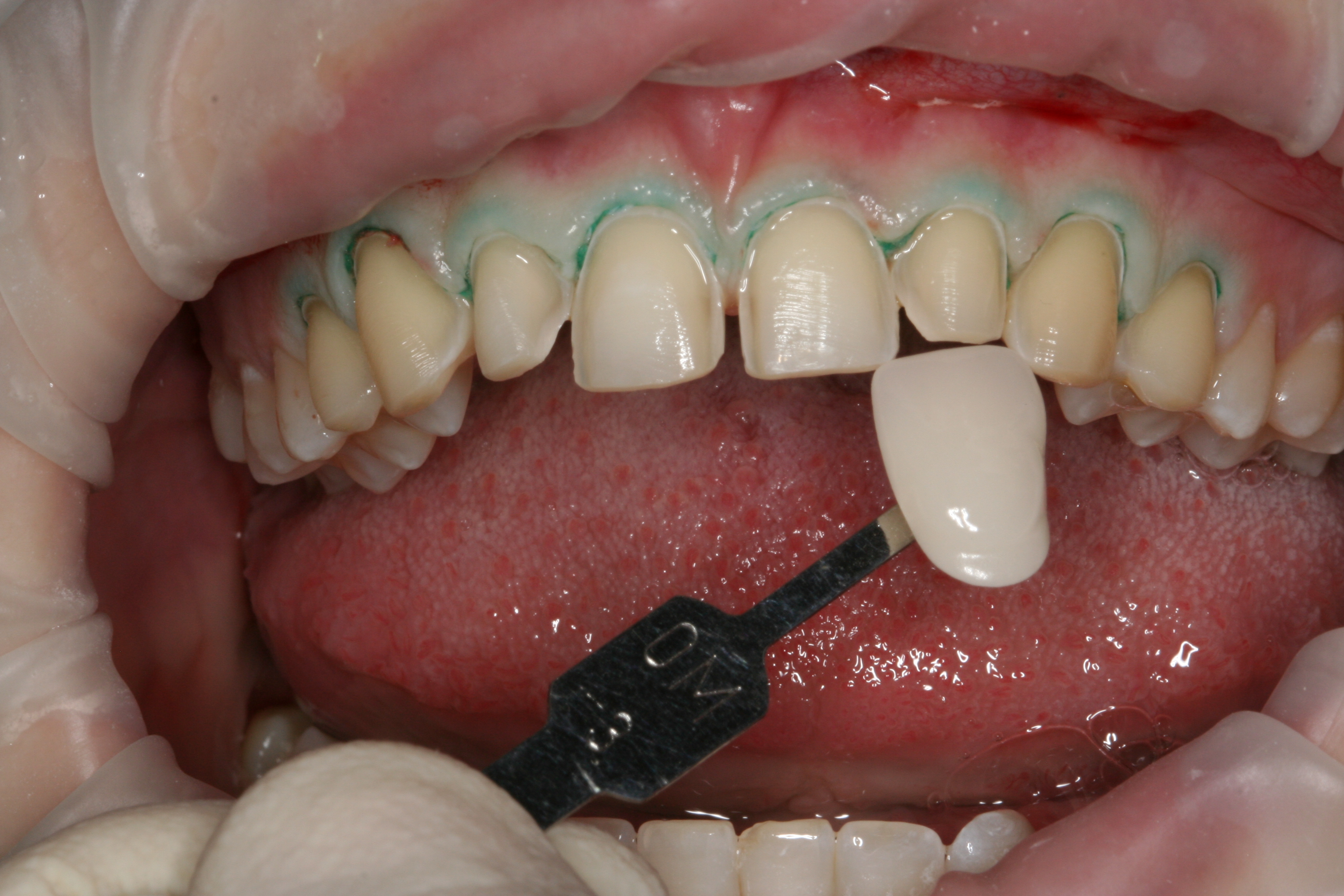 Cosmetic Dentistry Case Studies FirstBite Melbourne Cosmetic Dentist