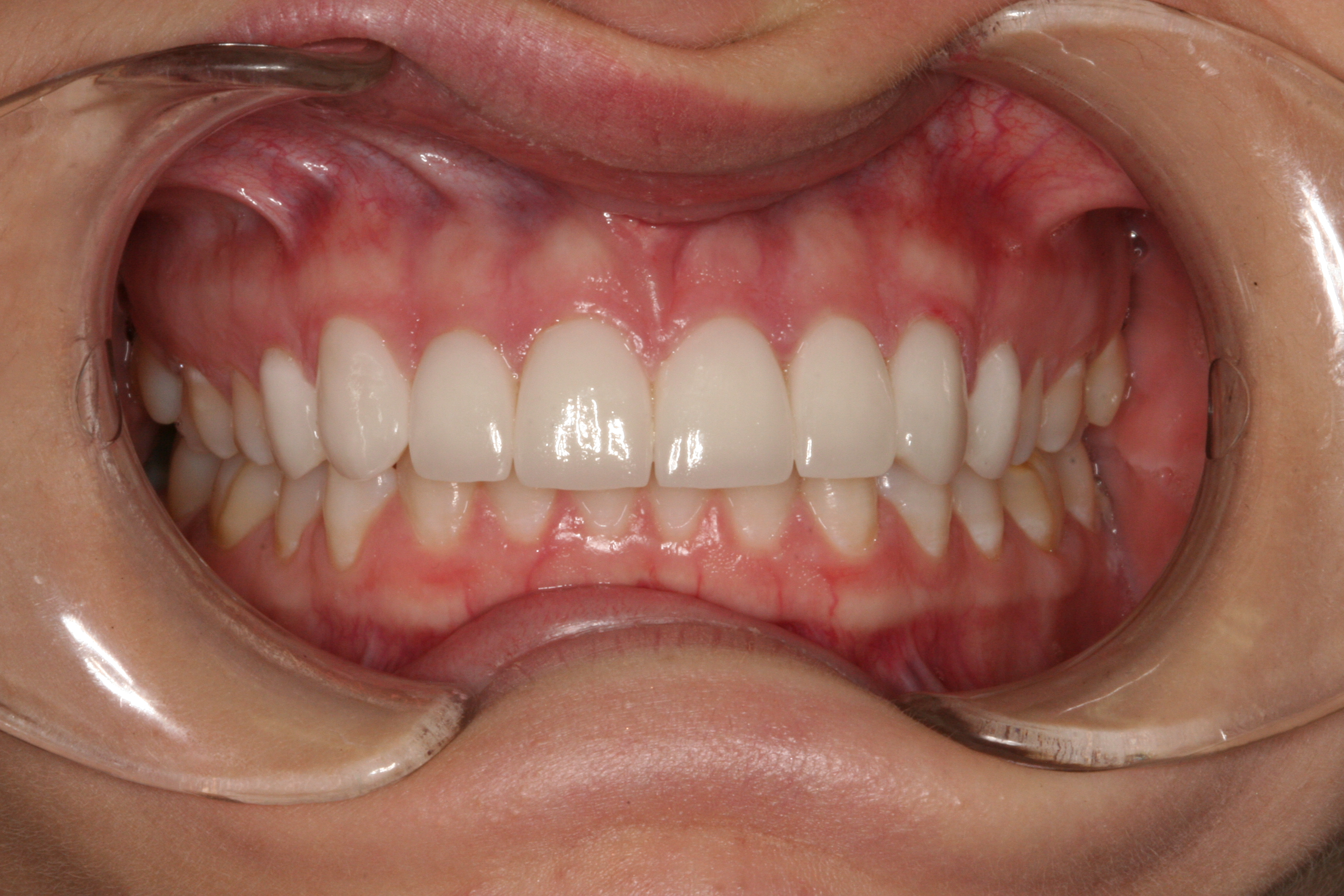 Cosmetic Dentistry Case Studies FirstBite Melbourne Cosmetic Dentist