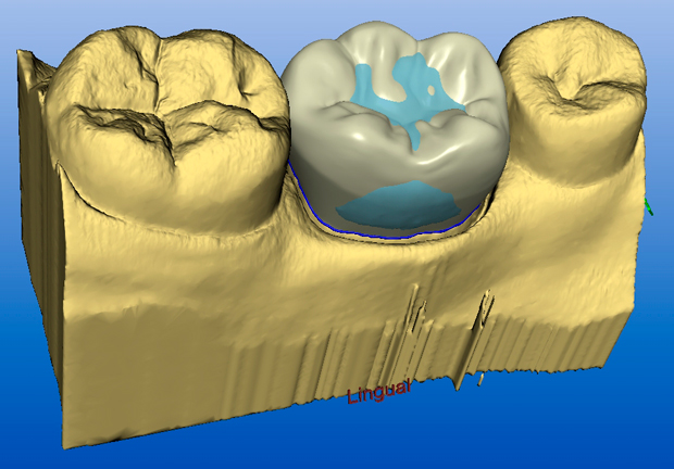 CEREC crowns in a single visit FirstBite Dental Essendon Dentist