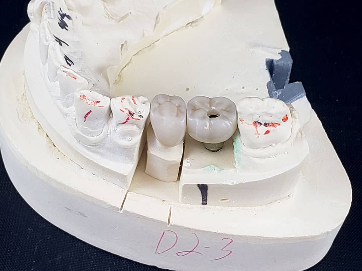 Loose Abutment Screw? You're Not Alone. First Choice Dental Lab