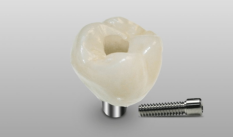 Crown and Bridge Restorations First Choice Dental Lab