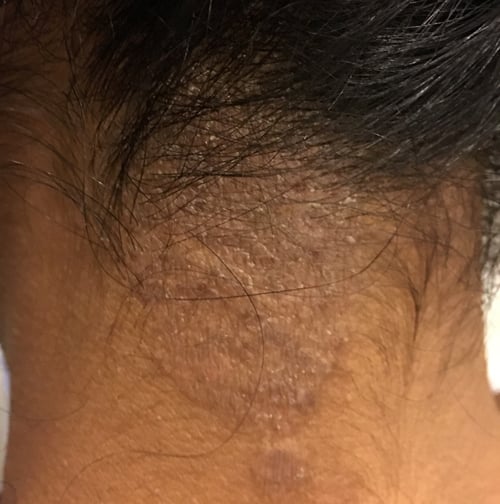 Itching Rash At The J.p. Morgan Healthcare Conference In San Francisco