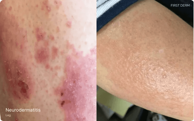 Heat Rash vs. Eczema How to Tell the Difference First Derm