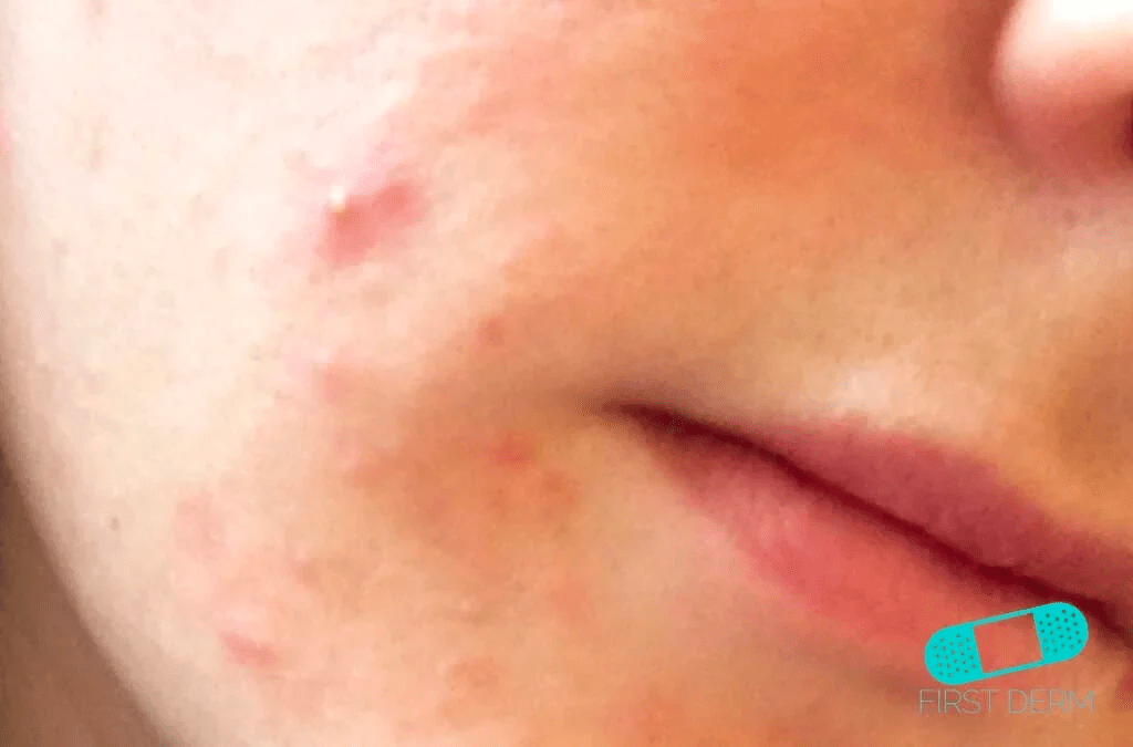 ACNE FROM STEROIDS SHOULD YOU BE WORRIED?