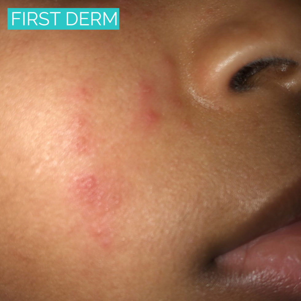 ACNE FROM STEROIDS SHOULD YOU BE WORRIED?