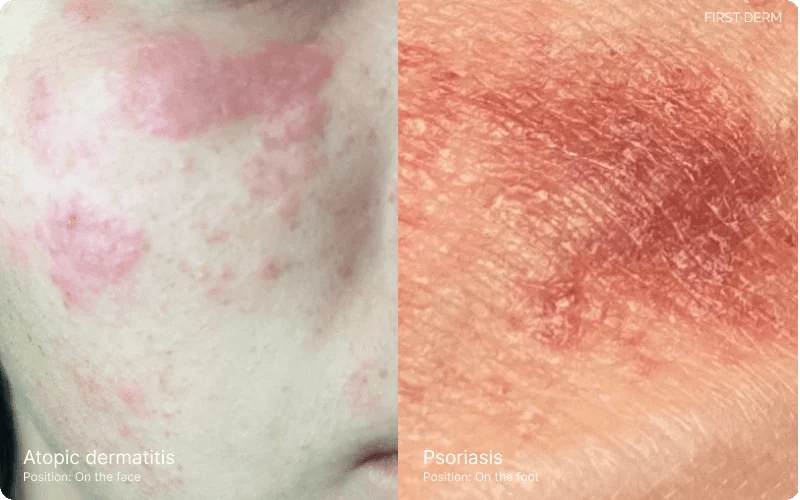 Eczema (Atopic Dermatitis) vs. Psoriasis Understanding the Differences