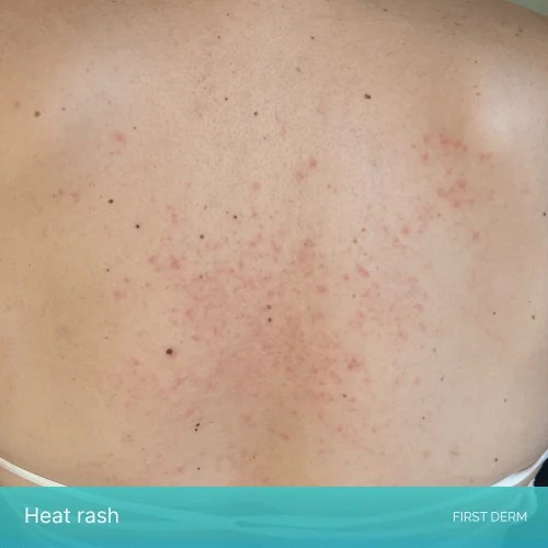 Breast rashes A symptom of cancer or something else First Derm