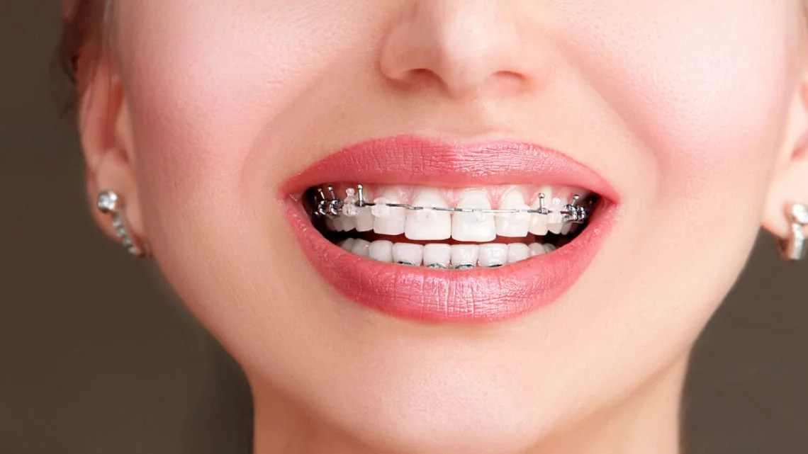 Are SelfLigating Braces a Good Option For Your Child? First impression