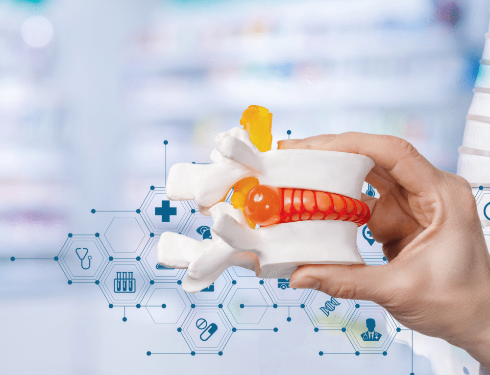 Introducing the Intracept Procedure for Low Back Pain First State Spine