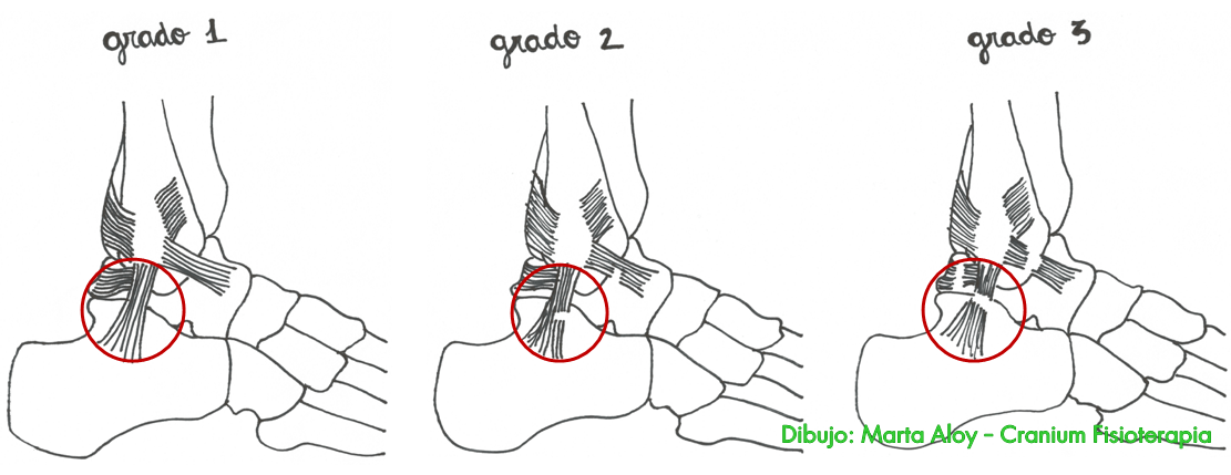 Fisioterapia Cranium Esguince de tobillo, tratamiento y recuperación