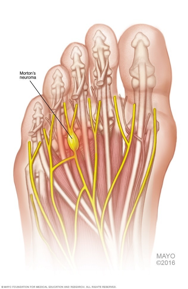 So What Is Morton’s Neuroma? Fit2Function Clinics