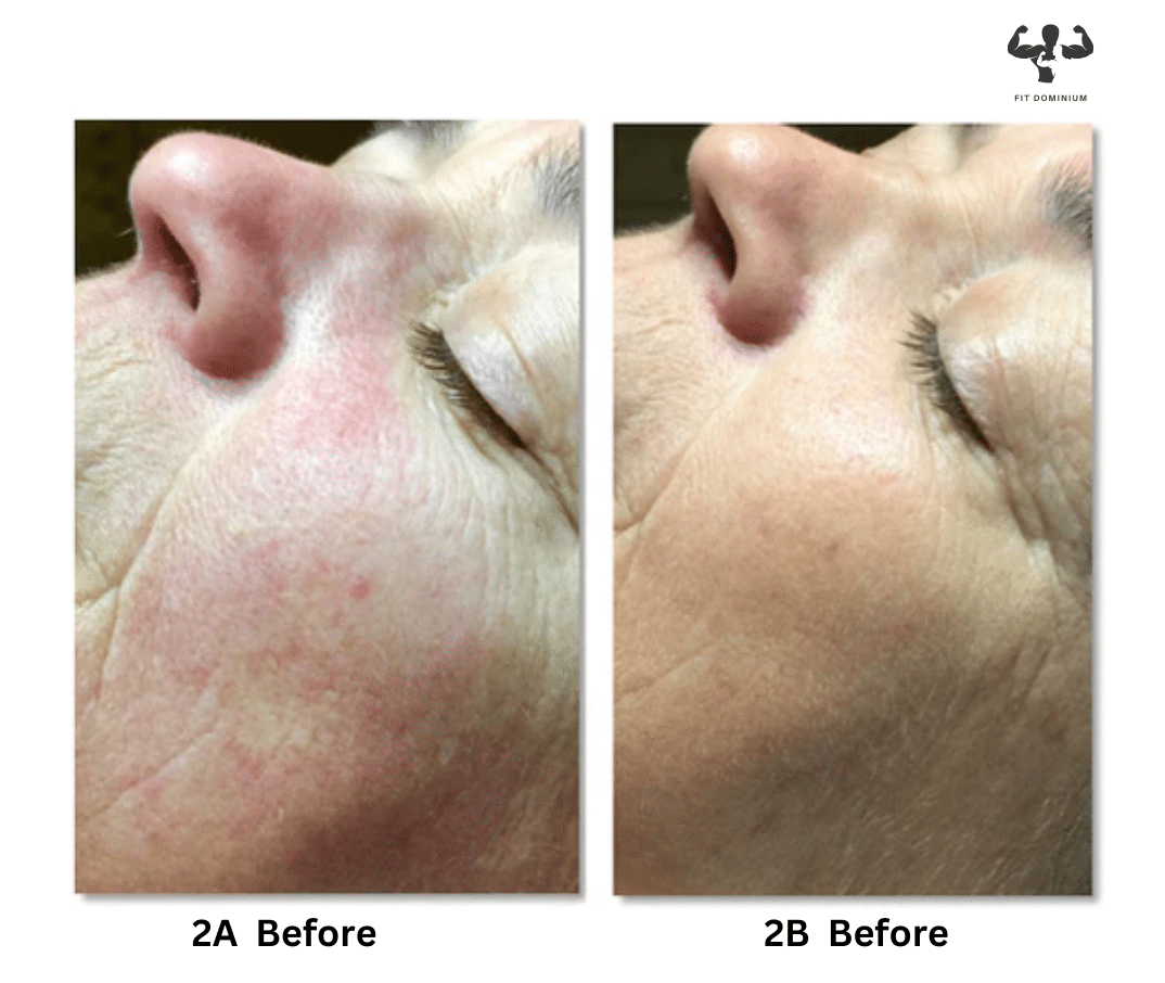 Red Light Therapy Before And After The Results FitDominium