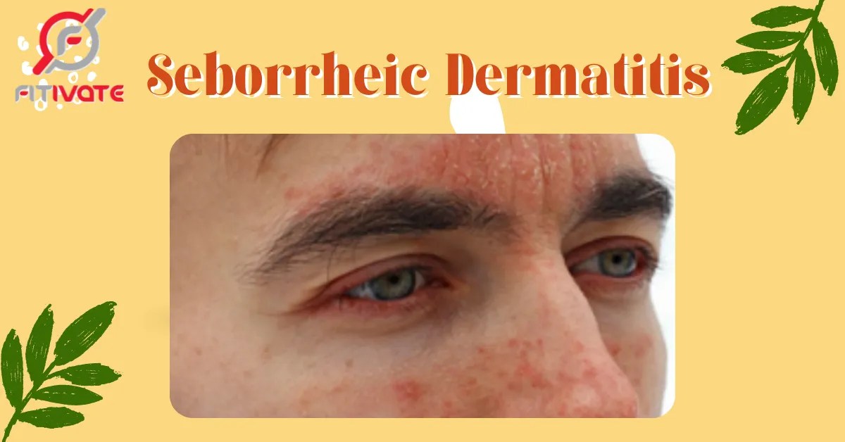 Seborrheic Dermatitis Treatments that work!