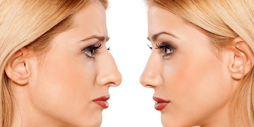 Get Natural Looking Results with a Skilled Rhinoplasty