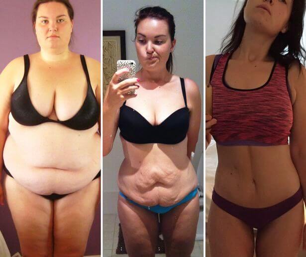 Life After Weight Loss With Bariatric Surgery Fitoont