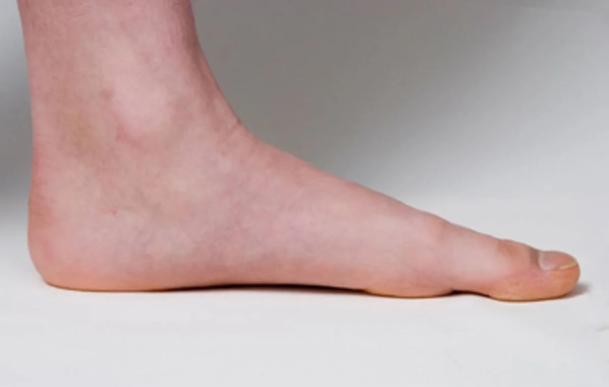 Can Orthotics Help to Alleviate Pain or Correct Flat Feet? Fits Perfect