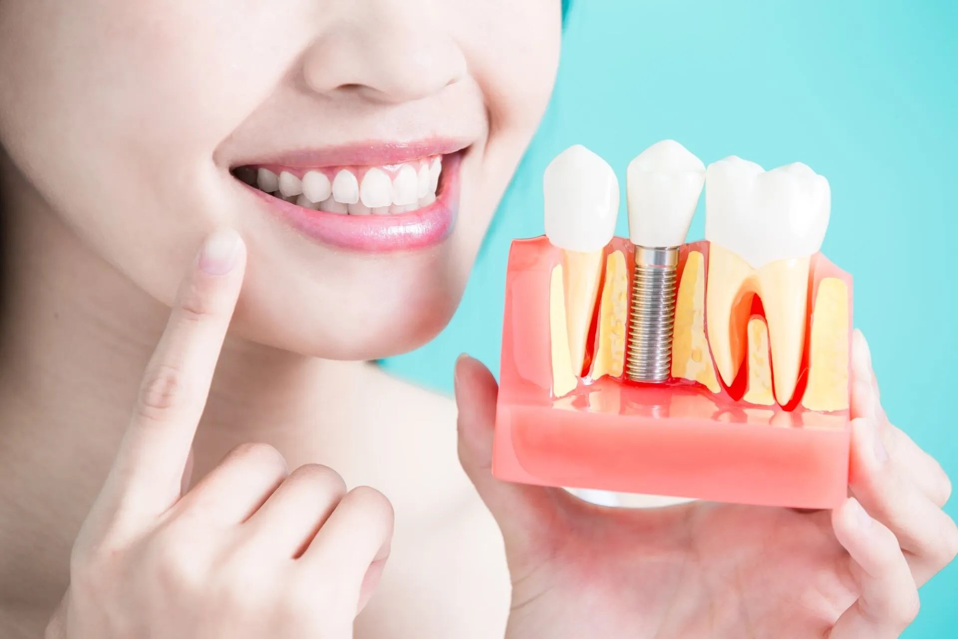 Smile Bright The ToothSaving Power of Dental Implants Five Knowledge