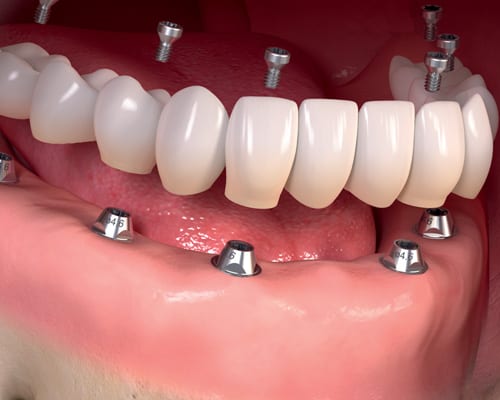 Denture stabilisation using full denture implants
