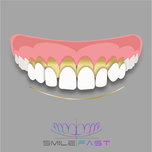 Composite Bonding Liverpool Smilefast 1 Day Smile Makeover