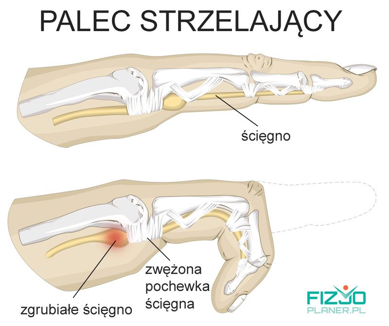 Palec strzelający przyczyny, objawy, leczenie I Fizjoplaner.pl