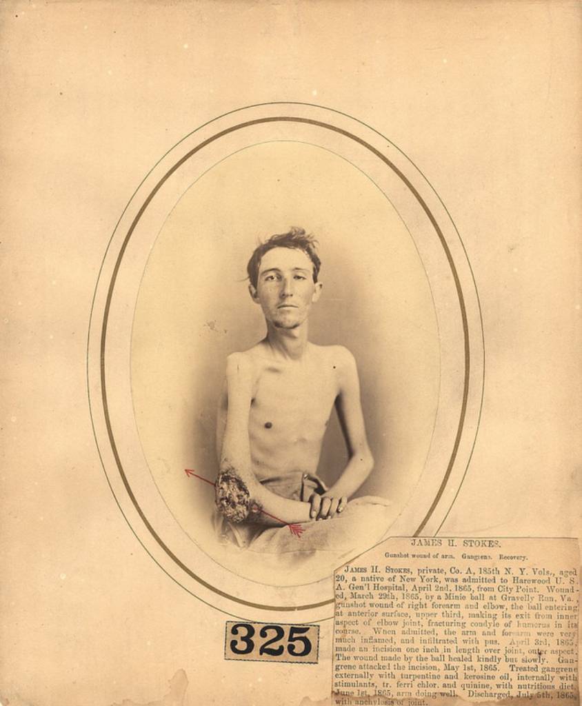 Dr Reed Bontecou's Stunning Pictures Of Wounded Civil War Veterans