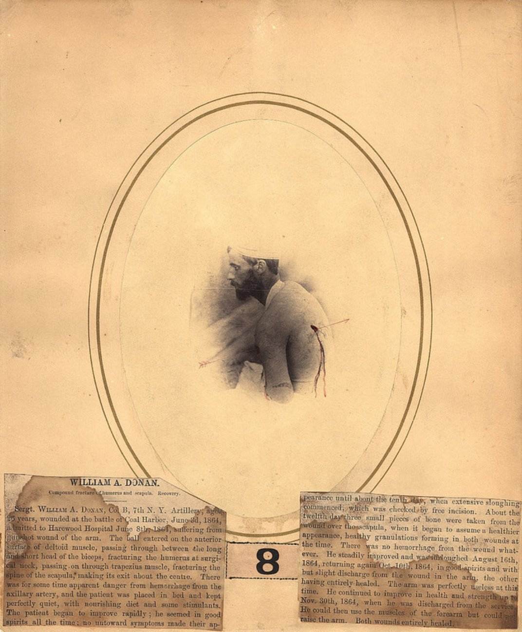 Dr Reed Bontecou’s Stunning Pictures Of Wounded Civil War Veterans