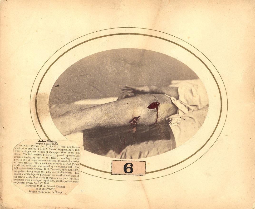 Dr Reed Bontecou’s Stunning Pictures Of Wounded Civil War Veterans