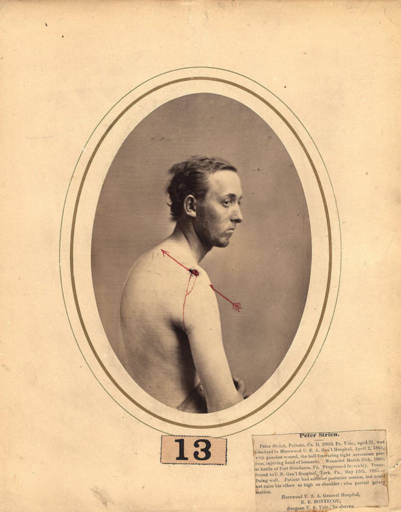 Dr Reed Bontecou's Stunning Pictures Of Wounded Civil War Veterans