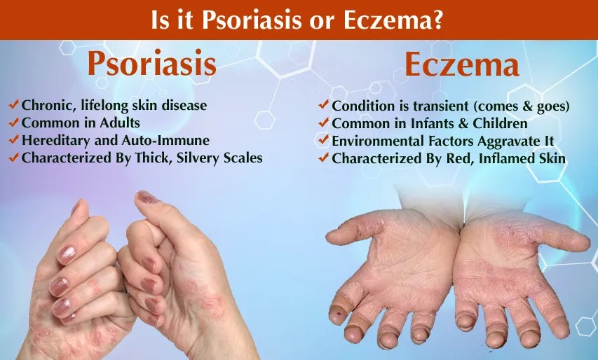 Differentiating Psoriasis and Eczema Symptoms, Causes, and Treatment Flash Uganda Media