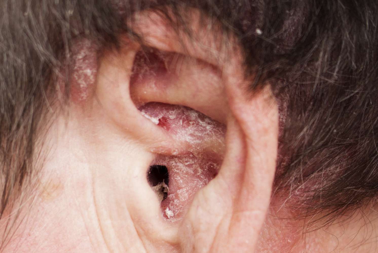 Managing Psoriasis Behind the Ear Tips for Relief and Prevention