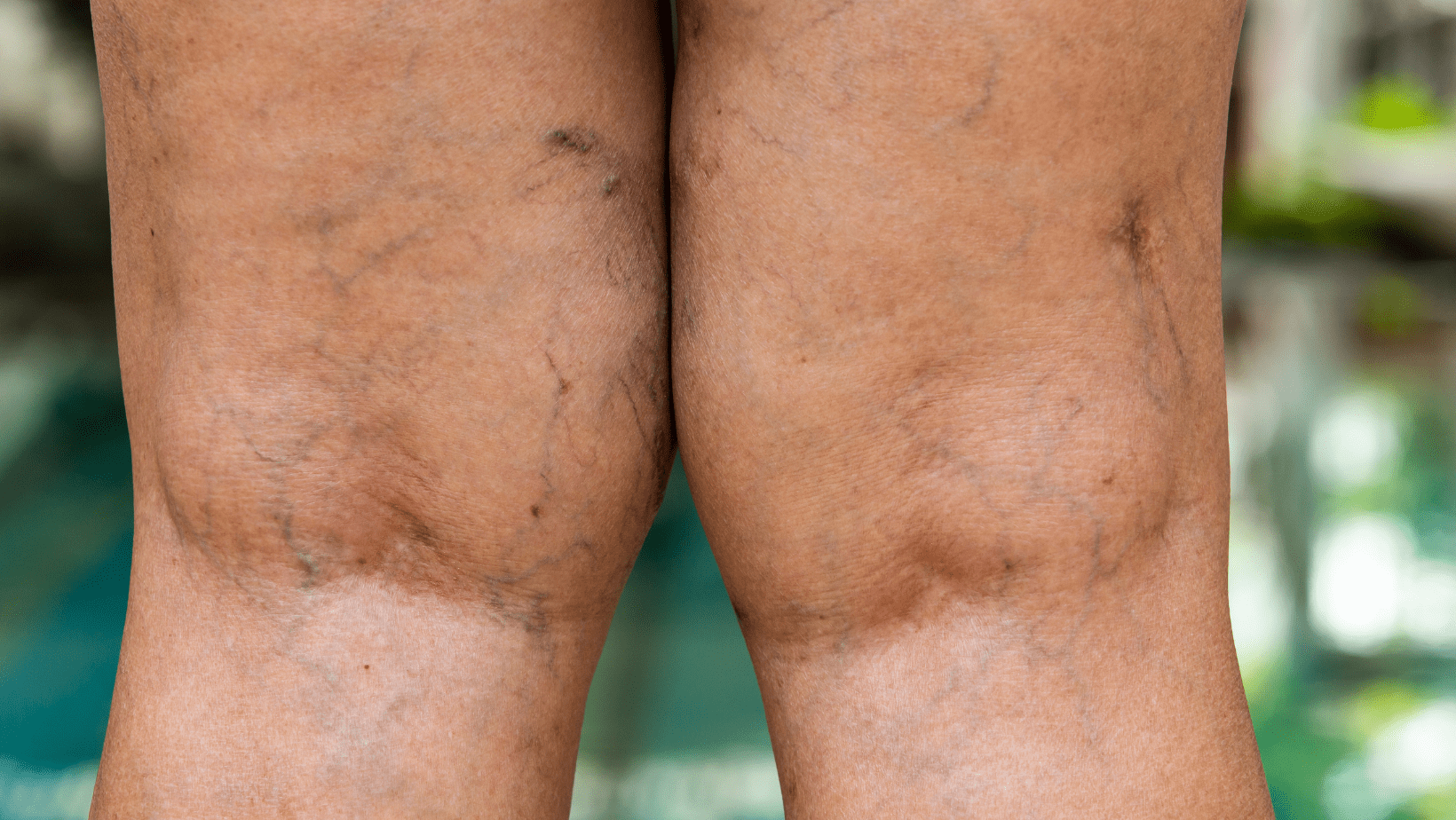 Baker's Cyst Treatment and How To Sleep With A Baker's Cyst