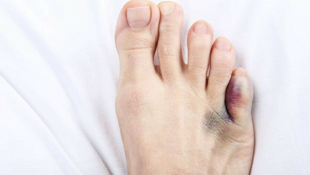 Pinky Toe Pain Learn the causes of Pain in your Little Toe