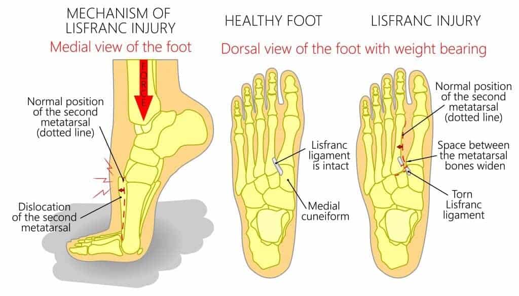 Midfoot Spain What is it, Diagnosis and Treatment Guidelines