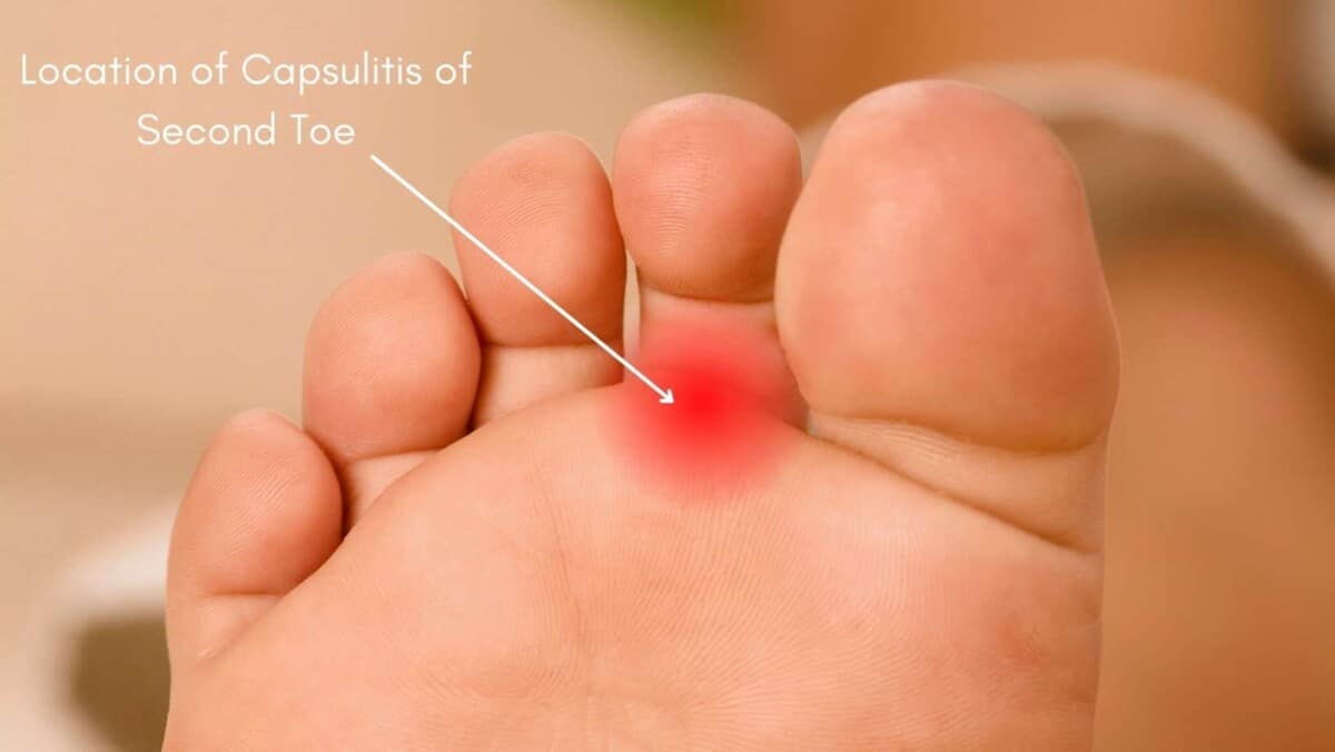 Capsulitis of the Second Toe Symptoms, Treatment and Exercises