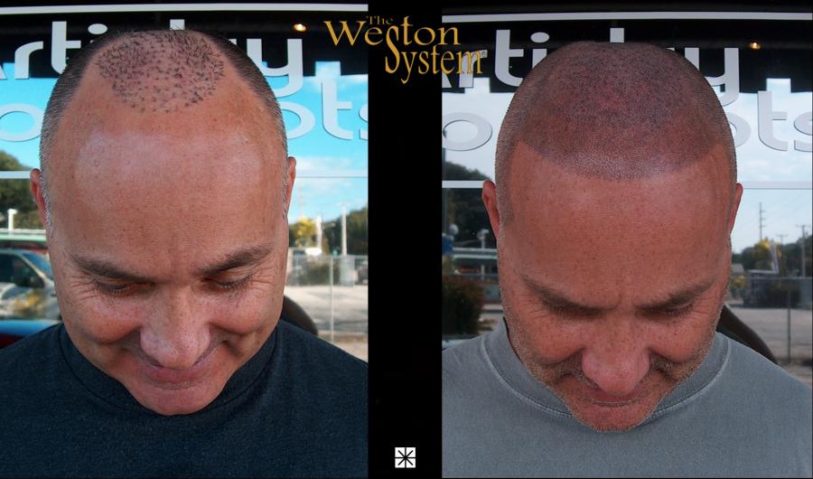 Failed Hair Transplant Victims Turn To Weston System℠ Patented Scalp