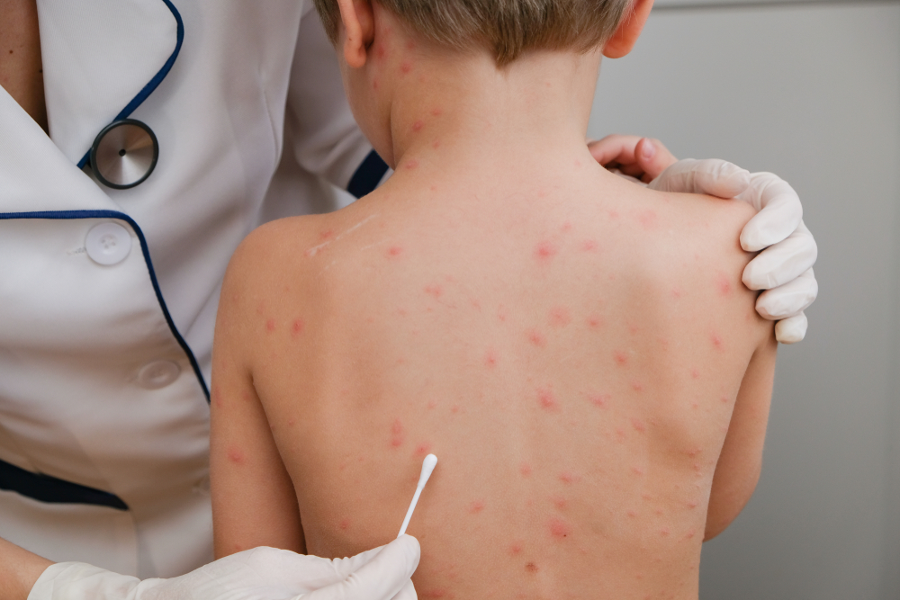 Childhood Skin Conditions | Florida Dermatology & Skin Cancer Centers