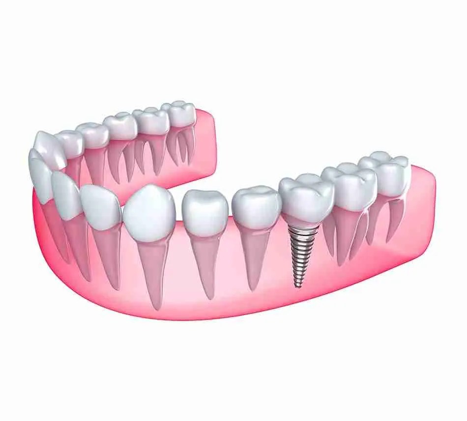 Expert Florida Dental Implants