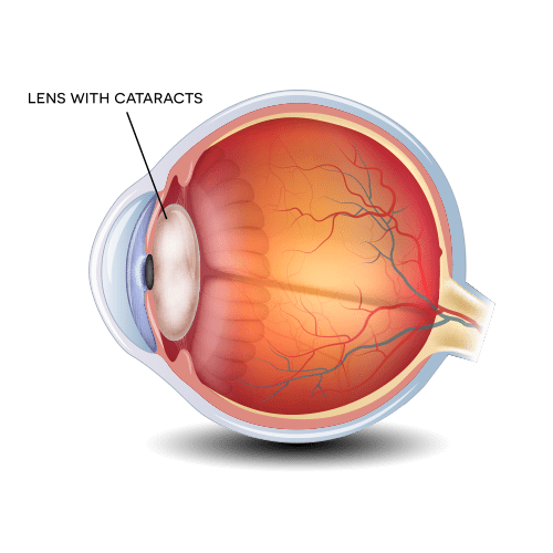 Cataract Surgery Information Florida Eye