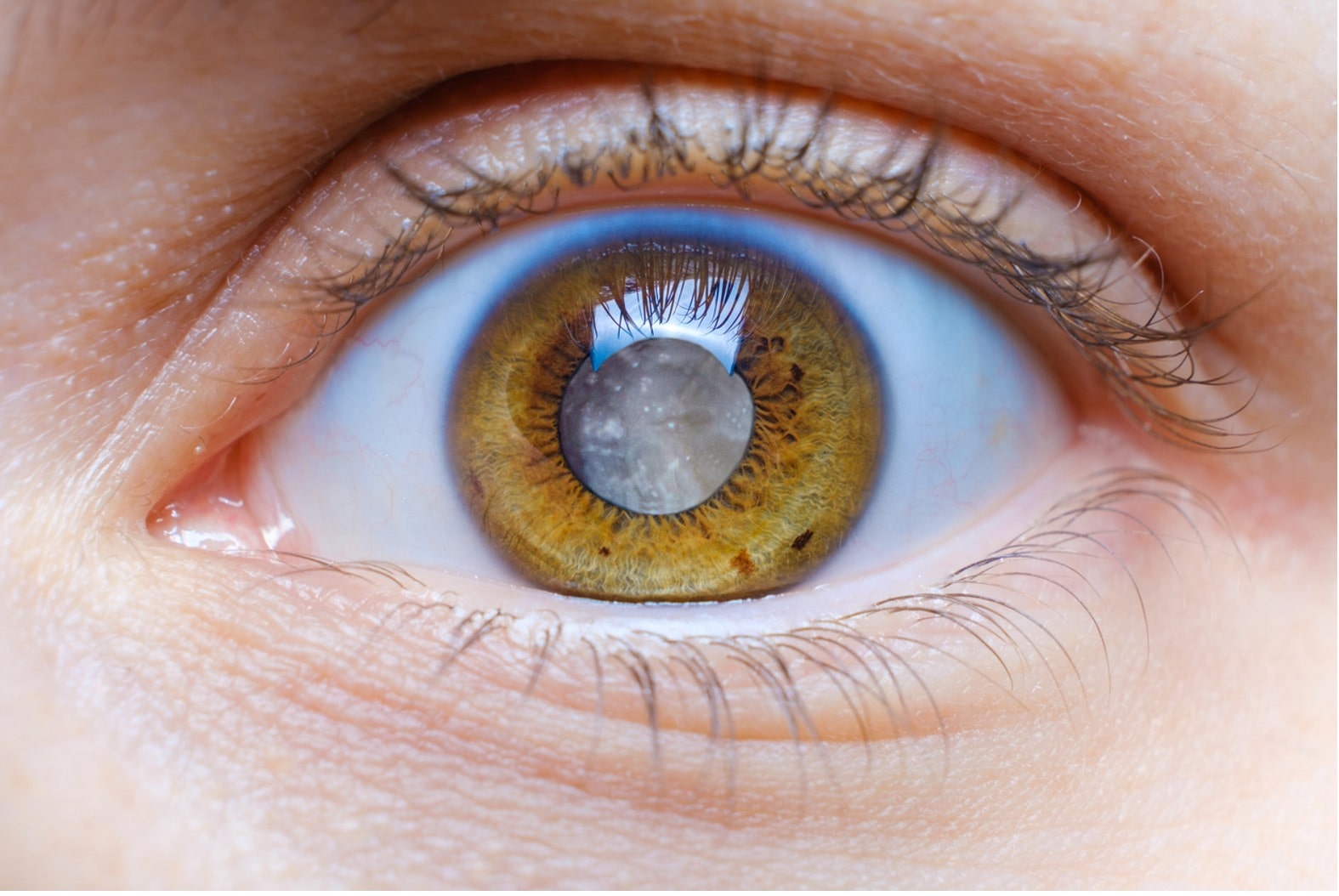Understanding Causes, Symptoms, and Treatment for Cataracts