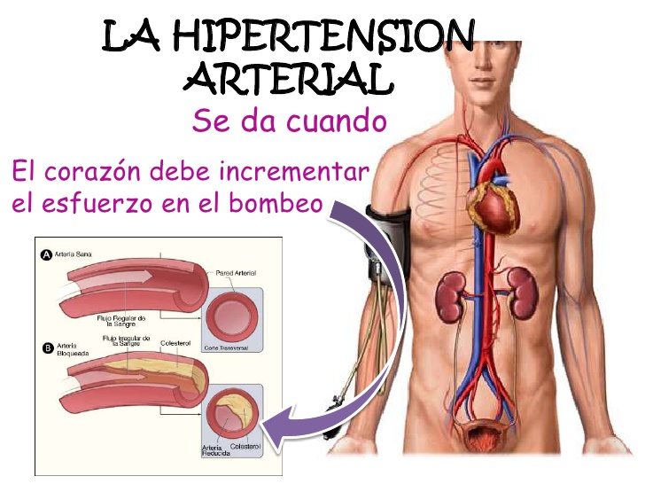 Secretaría de Salud la prevención contra la Hipertensión