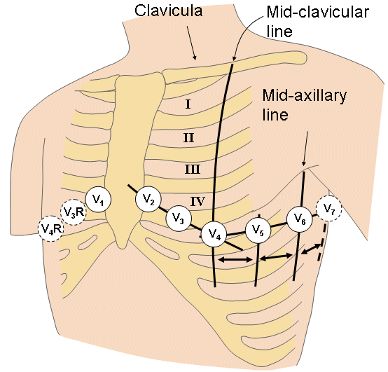 right ventricular myocardial infarction FOAMcast